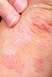 Eczema, treating eczema at Novato Dermatology