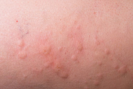 hives, allergic reaction, skin reaction