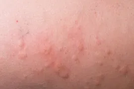 hives, allergic reaction, skin reaction