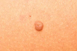 Moles, medically known as nevi, can be removed