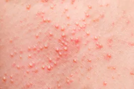rashes, skin rash treatment Novato Dermatology