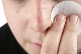 Young man with acne, acne treatments