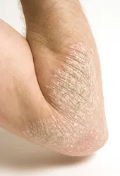 psoriasis, arm psoriasis treatment, psoriasis Novato CA
